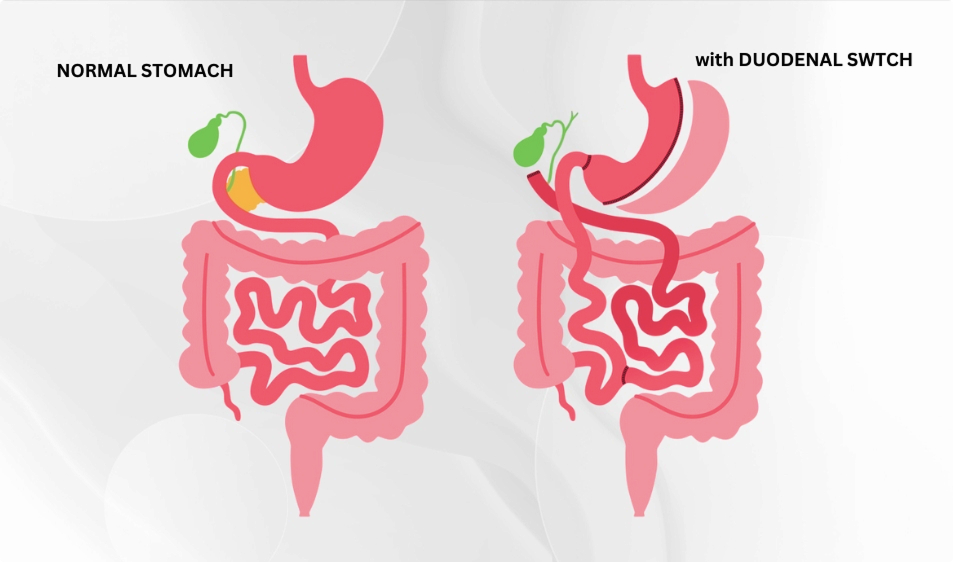 LOC Duodenal